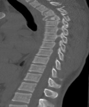 Tomografía axial computarizada de columna, que muestra fractura del cuerpo vertebral de T3 y T4 con invasión del canal medular.