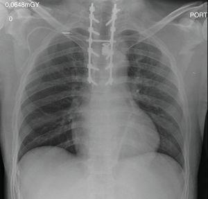 Radiografía postoperatoria de columna torácica con instrumentación y aplicación de cilindro e injerto óseo.