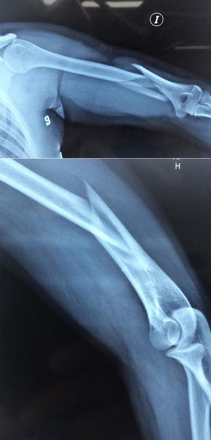 Radiografia anteroposterior y lateral de fractura de húmero diafisiaria distal.