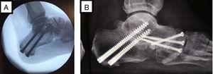 Doble artrodesis: fusión de las articulaciones subtalar y talonavicular. A) visualización fluroscópica durante el acto quirúrgico. B) radiografía lateral del retropié después de la cirugía.