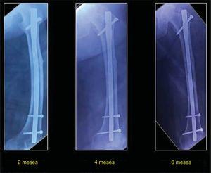 Radiografías a los 2, 4 y 6 meses tras el procedimiento quirúrgico.