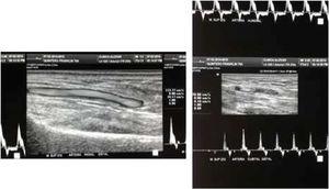 Ecodoppler: Buen flujo arterial y venoso en tronco humeral radial y cubital. Archivo del Dpto. de Imágenes Hospital Alcívar.