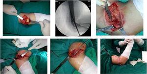 Reinserción de los músculos epitrocleares con arpón de titanio en codo izquierdo. Archivo fotográfico Hospital Alcívar.