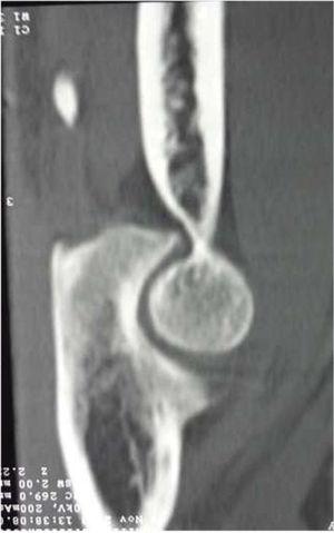 TAC de codo derecho: Fragmento óseo de 12x5mm, localizado a 20mm de extremo proximal del cubito – fractura de olecranon. Archivo del Dpto. de Imágenes Hospital Alcívar.