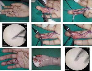 Reinserción de tendón profundo de 4to dedo de mano derecha con miniarpon de titanio y sutura. Archivo fotográfico y radiológico del Hospital Alcívar.