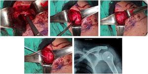 Acromioplastia más rafia del tendón del supraespinoso con sutura arponada en hombro izquierdo. Archivo fotográfico Hospital Alcívar.