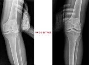 Radiografía de stress en valgo y varo de la rodilla izquierda.