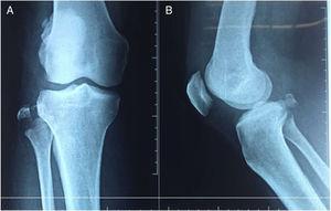 A) Radiografía anteroposterior de la rodilla derecha. B) Radiografía lateral de la rodilla derecha. Inicial.