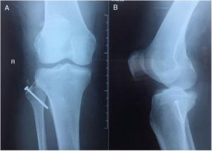 Radiografías de control posquirúrgico: A) Radiografía anteroposterior de la rodilla derecha. B) Radiografía lateral de la rodilla derecha.