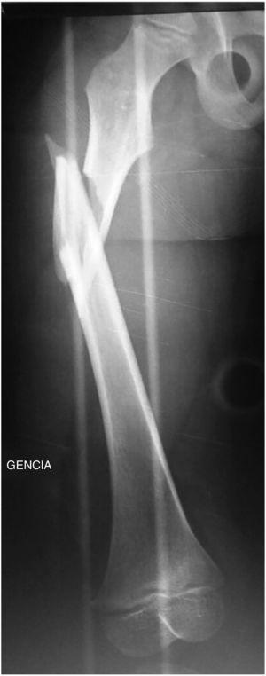 Radiografía de fractura subtrocantérica de fémur derecho multifragmentaria desplazada con fragmento distal acortado y con rotación externa patológica.