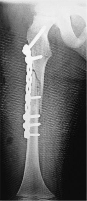 Proyección radiográfica de fémur derecho posquirúrgica inmediata, fractura fijada mediante placa de reconstrucción.