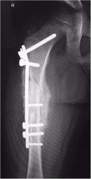 Proyección radiográfica de fémur derecho posquirúrgica a 6 semanas de intervención: fractura fijada mediante placa de reconstrucción; se aprecia callo óseo exuberante.