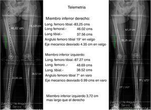 Telemetría radiográfica de miembros inferiores en la que se evidencia una discrepancia de 3,72cm. Fuente: Archivos médicos Hospital Alcivar.