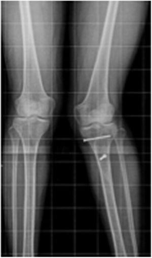 Radiografía de rodilla izquierda en la que se evidencia deformidad en valgo. Fuente: Archivos médicos Hospital Alcivar.