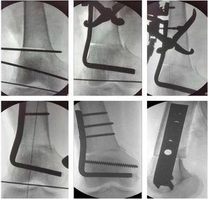 Secuencia radiológica de la osteotomía y su fijación con placa angulada de 95°. Fuente: Archivos médicos Hospital Alcivar.