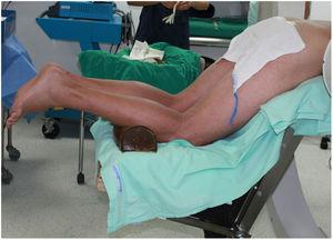 Paciente en decúbito prono con angulación de las caderas en 90 grados de flexión.