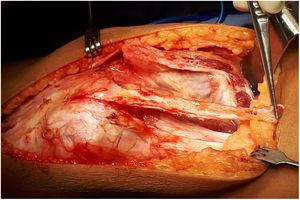Retiro de injerto. La imagen muestra el momento quirúrgico en el que se toma el injerto de la porción medial del cuádriceps.