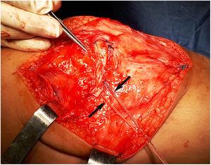 Anclaje de injerto. En la imagen, el injerto está sobre la cápsula articular para colocarlo en su punto isométrico. La sutura de anclaje se usa para insertar el tendón en esta posición (flechas).