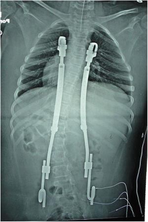 Paciente escoliosis neuromuscular post-operatorio Implantación de Costillas Expansora de Titanio – Costillas / pelvis Vista radiográfica anterior-posterior.