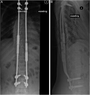 A: 6 años paciente femenino con barras electromagnéticas Vista antero-posterior Figura 5B. Vista lateral.
