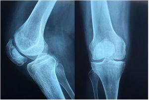 Radiografías de rodilla derecha, lateral y anteroposterior.