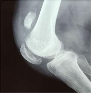 Radiografía peri-operatoria lateral de rodilla derecha