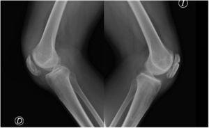 Radiografías laterales de rodilla postoperatorias.