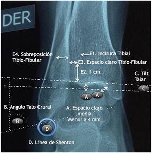 Radiographic measurements of the ankle (Taken from Pelaez L, Reina E, Herrera JM. Ankle Lux fractures. Rev Lat Ort. 2014; 2 (1); 61-78.).