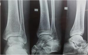 Clinical Case 1 Image. Unilateral fracture series.