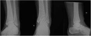 Clinical Case 4 Image. Unilateral fracture series.