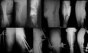 Un paciente de 36 años de edad con un resultado funcional pobre manejado con fijación externa. Las fracturas fueron clasificadas como Tipo III C – fractura distal y de diáfisis femoral con fractura de platillos y de diáfisis de la tibia – según la clasificación de Fraser Modificada.