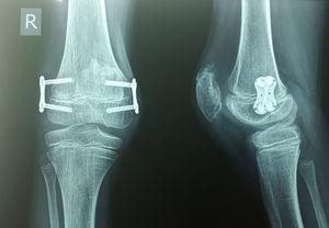 Radiografía que muestra material de osteosíntesis de la articulación patelar posterior a resección de tumor.