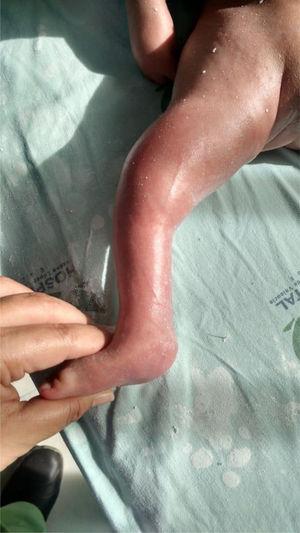 Evaluación de la dorsiflexión en paciente con PEVC asociado a artrogriposis. Fotografía con autorización del acudiente del paciente.