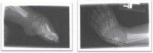 Radiografías de un pie atípico: A la izquierda, proyección lateral del pie en la que se resalta la flexión plantar extrema de los metatarsianos (cavo). También se evidencia la flexión plantar del calcáneo y del talo. La imagen de la derecha, pie en proyección anteroposterior, resalta el aducto del antepié y el varo del retropié, por disminución de la divergencia entre el talo y el calcáneo.(10).