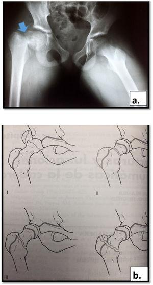 a. Fractura de cuello femoral desplazada b. Clasificación de Delbet de las fracturas de cadera en niños y adolecentes.