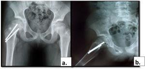 a. Radiografía de cadera proyección AP y b. lateral muestran fractura consolidada.