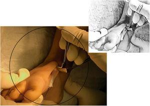 Incisión dorsal interna del pie, y desinserción del tibial anterior.