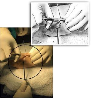 Paso de pinza desde incisión lateral hacia la incisión dorsal interna sobre los tendones extensores y recuperación del tendón por la incisión lateral.