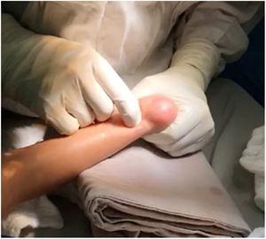 Marcación del sitio de incisión uno a dos cm. proximales a la inserción del tendón de Aquiles en el calcáneo.