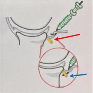 Punto de plicatura de capsula posterior, la flecha roja señala el nervio Axilar protegido tras el paso del punto de sutura en la cápsula, la flecha azul señala la plicatura del nervio Axilar con el punto al sobrepasar los 5mm de seguridad del reborde glenoideo.