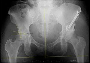 Cadera derecha con displasia residual e indicación de osteotomía periacetabular. Cadera izquierda post artroscopia de cadera y osteotomía periacetabular.