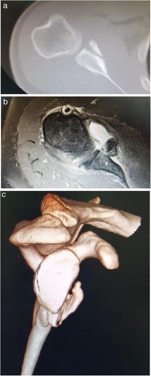 a. b. TC axial y c. reconstrucción 3D que demuestra la pérdida de stock de hueso glenoideo anterior (aproximadamente> 30% de defecto).