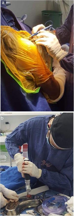 Fotografía intraoperatoria de a. el abordaje quirúrgico de la disección del hombro y b. la preparación del injerto con las medidas indicadas de déficit glenoideo.