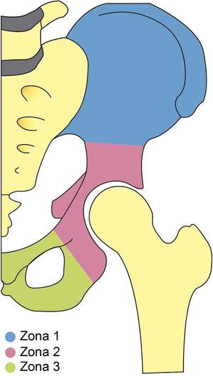 Ilustración de la clasificación de Enneking WF y Dunham WK, en la que se divide la pelvis para describir el compromiso de la lesión en región iliaca (zona 1 en sombreado azul), acetabular (zona 2 en sombreado rojo) o en región isquion pubis (zona 3 en sombreado verde).