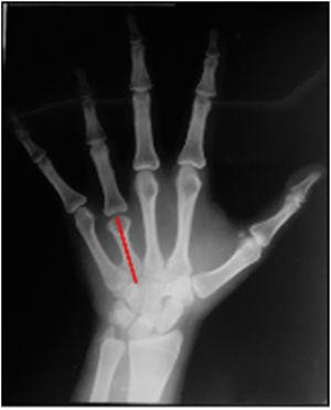 RX de F de la mano izquierda que evidencia la braquimetacarpia del 4° metacarpiano.