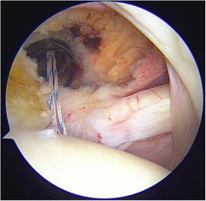 Remodelación del muñón proximal con lo cual se termina la tenodesis del Bíceps.