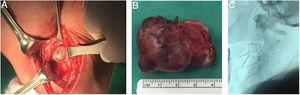 A) Masa tumoral prevertebral vista mediante abordaje longitudinal anterolateral izquierdo. B) Espécimen tumoral de masa prevertebral. C) Identificación radiológica transoperatoria de nivel cervical.