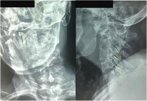 Radiografías AP y lateral de columna cervical.