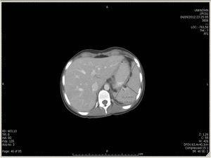 TAC de abdomen: hepatoesplenomegalia.