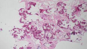 Presencia de cuerpos esféricos calcificados (calcosferitas).